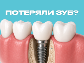 Потеряли зуб? Сегодня его можно вернуть так, что никто даже не заметит